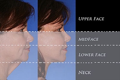 Breast implant placement comparisons: techniques illustrated.