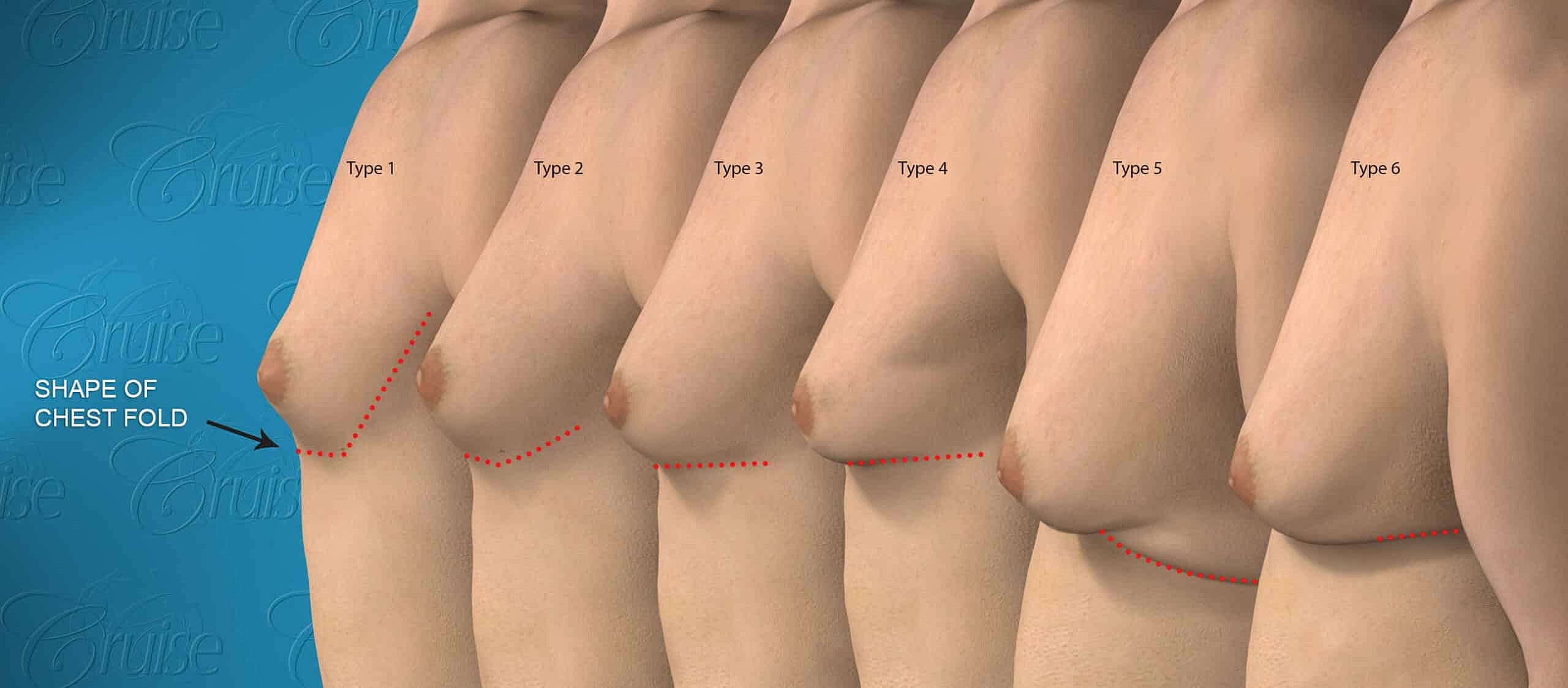 Breast types showing nipple positioning and relationship.