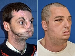 Amazing result of Face Transplant