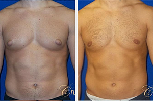 Consider Gynecomastia Surgery for a Boost in Confidence
