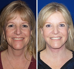Facelift Surgery in Newport Beach