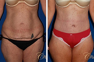 How much is a Tummy Tuck?