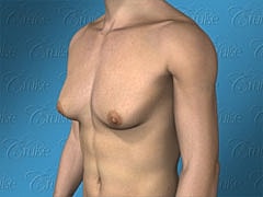 Will Liposuction Alone Correct Gynecomastia?
