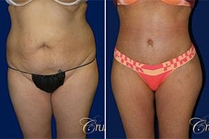 Liposuction vs Tummy Tuck