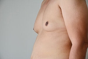 Los Angeles Surgeon Helps Improve Patient’s Quality of Life Through Male Breast Reduction Surgery