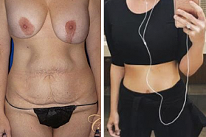 Mommy Makeover Recovery Time