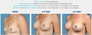 Natural Breast Augmentation Results