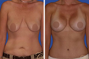 Optimize Your Cosmetic Surgery with the Perfect Combination of Procedures