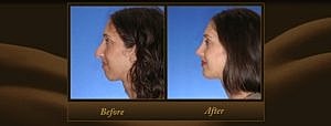 Rhinoplasty Surgeon Uses Innovative Technology to Show Patients Possible Results Pre-Surgery
