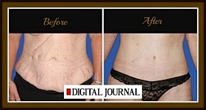 Tummy Tuck Surgeon, Dr. Joseph T. Cruise, Outlines Benefit of Extended Tummy Tuck vs. Standard Tummy Tuck