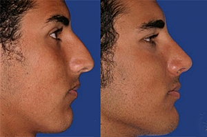 Tips for Recovering from your Rhinoplasty Procedure