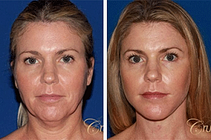 Stages of Facelift Recovery Explained
