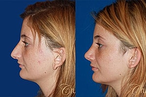 The Do’s and Dont’s When Recovering from Rhinoplasty