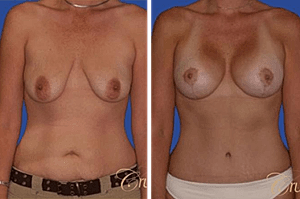 Tips for a Smooth Mommy Makeover Recovery