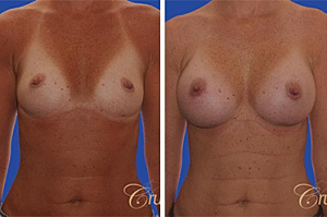 Tips for an Easy Breast Augmentation Recovery