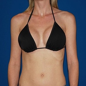 Top 5 Techniques Plastic Surgeons Use to Create Natural Cleavage