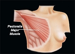 Understanding Breast Implant Placement – Over the Muscle & Under the Muscle