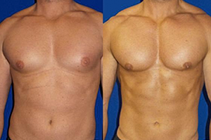What Causes Gynecomastia?