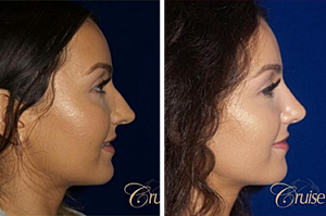 What Not To Do After Rhinoplasty