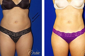 What You Need to Know About Liposuction and Tummy Tucks