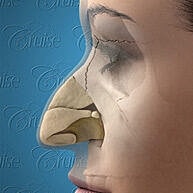 Profile illustration of a nose improvement procedure.