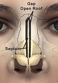 Illustration of nasal anatomy and septum structure.