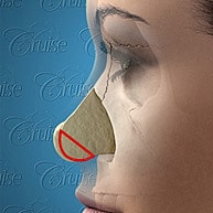 Nose illustration for cosmetic surgery reference.