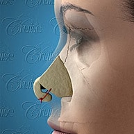 Anatomical illustration of a rhinoplasty procedure.