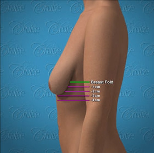 Breast fold measurement illustration for cosmetic purposes.