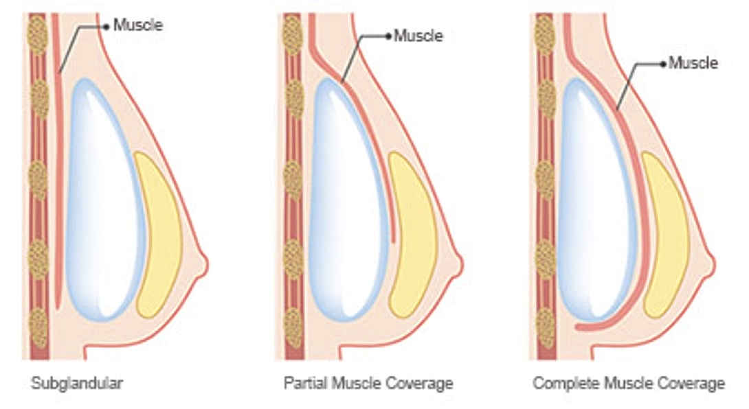 Types of muscle coverage in breast implant placement