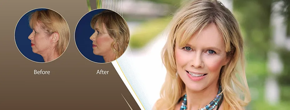 Before and after photo of facial rejuvenation.