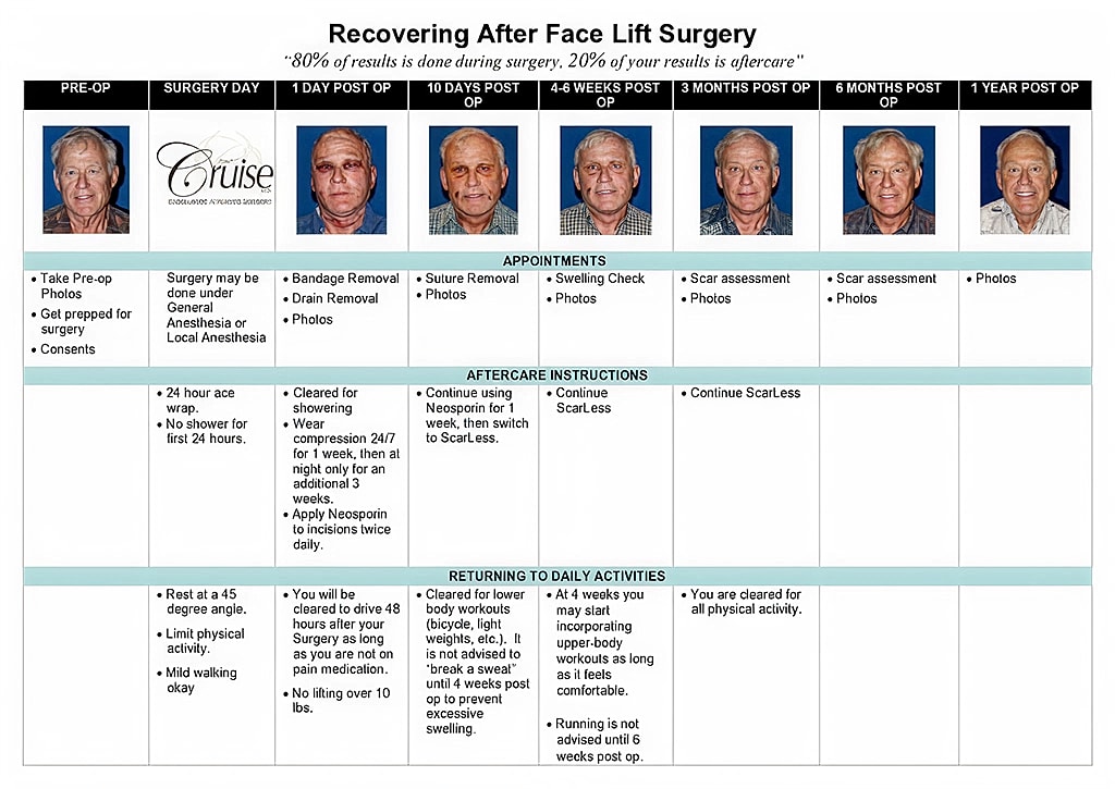Face lift surgery recovery timeline and instructions.
