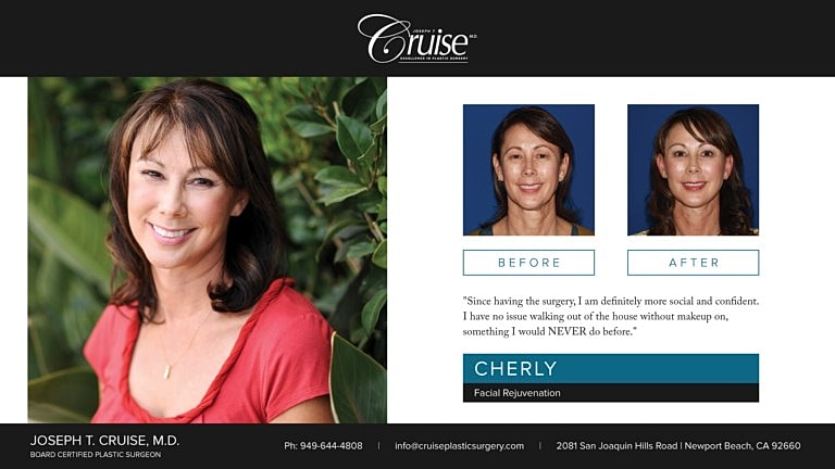 Patient transformation: before and after facial rejuvenation.