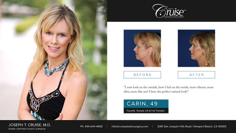 Before and after facelift and fat transfer image.