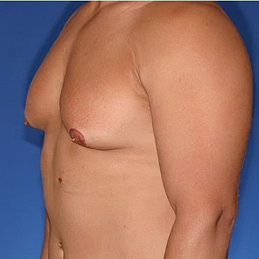 gynecomastia-type-3s