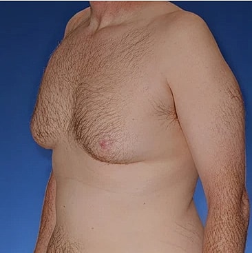 gynecomastia-type-4s