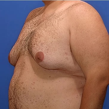 gynecomastia-type-5s