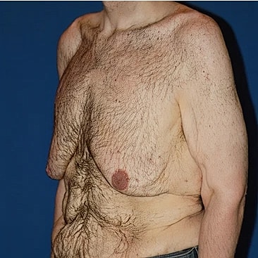 gynecomastia-type-6s