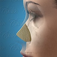3D model of a nose surgery procedure.