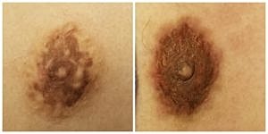 Skin lesions before and after treatment.
