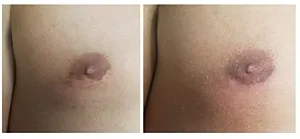 Comparison of two skin lesions on abdomen.