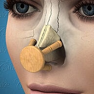 Conceptual image of a nose reconstruction model.