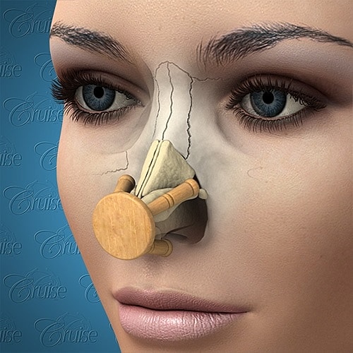 Illustration of nasal surgery procedure on a face.