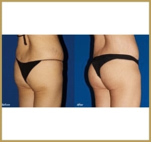 Before and after body contouring procedure.