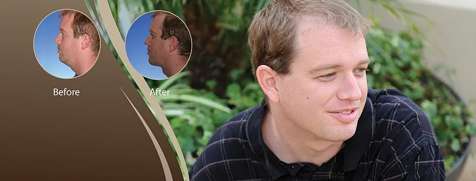 Side profile comparison before and after transformation