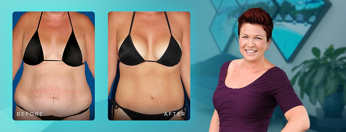 Before and after body transformation comparison image.