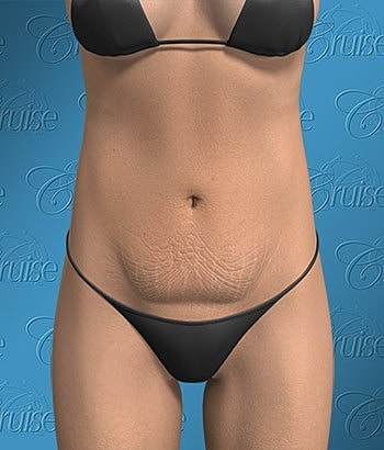 Body image showcasing stretch marks and bikini.