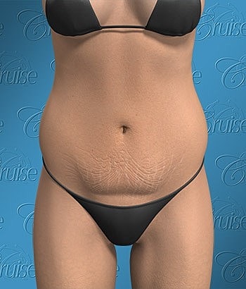 Woman in bikini displaying stretch marks.