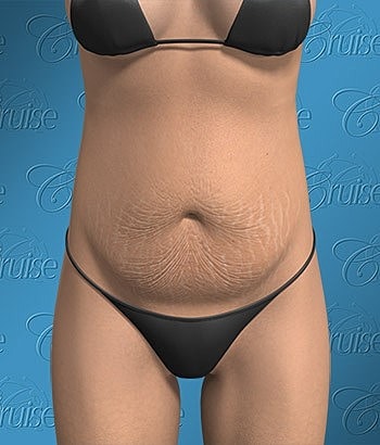 Model showcasing skin with stretch marks.