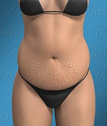 Person in bikini showing stomach with stretch marks.